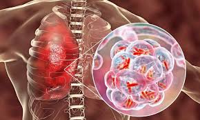 Understanding Legionnaires Disease Causes, Symptoms, and Prevention