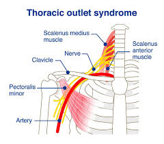 Understanding Thoracic Outlet Syndrome: Causes, Symptoms, and Effective Treatments