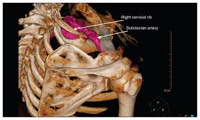Understanding Thoracic Outlet Syndrome Causes, Symptoms, and Effective Treatments