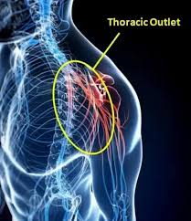 Understanding Thoracic Outlet Syndrome Causes, Symptoms, and Effective Treatments